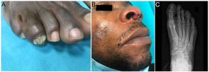 A) Dactylitis and nail dystrophy on the fourth toe of the right foot. B) Papules and erythematous-orange plaques on the nasal columella and labial commissures (arrowheads) corresponding to cutaneous sarcoidosis (lupus pernio). C) The radiological image shows bone resorption of the distal phalanx of the fourth toe of the right foot.