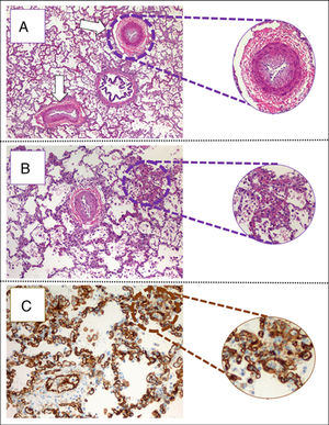 (A) Pulmonary parenchyma showing two veins with marked intimal hyperplasia and patched thickening of alveolar septum (eosin hematosilin, 4×). (B) Detail of alveolar septshes demonstrating a thickening produced by a proliferation of capillary lights (eosin–hematosilin, 10×). (C) Immunohistochemical staining for CD31 that shows the proliferation of hair lights (CD31, 20×).