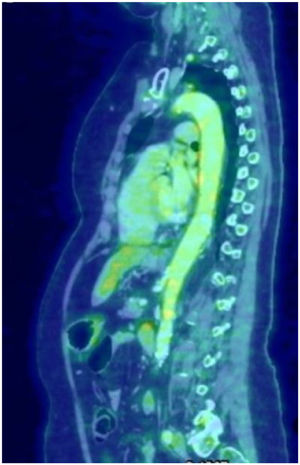 PET: increased metabolic activity of the aorta artery along its entire length.