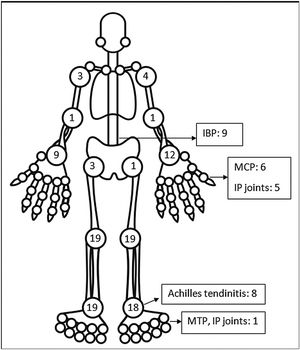 Frequency of joint involvement in post-COVID ReA patients.