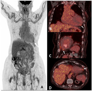 PET/CT with 18F-FDG. Anterior view of the whole-body MIP (maximum intensity projection) image, showing a hot spot on the myocardial apex (white arrows) (A); in coronal (B), sagittal (C) and axial (D) fused images of the PET/CT scan.