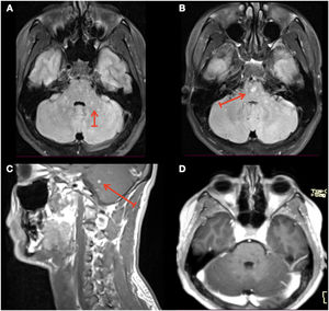 (A, B) MRI of the brain T2 Flair at presentation with hyperintense lesions (arrows). (C) MRI of the brain T1 post-gadolinium at presentation, showing foci of pontine “peppering” enhancement lesion highly suggestive of a perivascular distribution. (D) MRI of the brain T1 post-gadolinium at one-month follow-up showing full recovery after corticosteroids treatment.