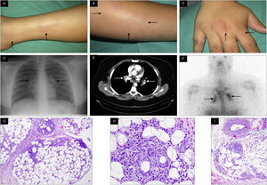 (A and B) Skin lesions in the form of erythematous indurate papules at pretibial level on the right leg and left forearm, respectively, indicative of erythema nodosum. (C) Tumefaction of the right hand, indicative of periarthritis. (D, E and F) Simple x-ray of the thorax, CT image of the thorax and gallium-67 gammagraphy showing bilateral hilar lymphadenopathies. (G, H and I) Histopathology of a skin lesion showing predominantly septal histiocytic inflammatory infiltrate, without necrosis or vasculitis.