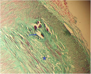 Masson Trichrome, 200×. The histopathological evaluation of temporal artery biopsy specimen; Monckeberg
