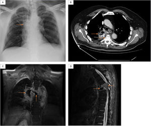 (A) Chest X-ray: right paratracheal infiltrates. (B) Chest CT: right lung consolidation occupying the azygo-esophageal recess, with aire-fluid level and calcium deposits, as well as a marked crush and destructuring located at the T5-T6. (C) Thoracic spine MRI (coronal): central necrotic-cystic zone occupyping the disc space of the T5-T6 and fistulous communication with the adjacent right lung injury. (D) Thoracic spine MRI (sagittal): diffuse gadolinium enhancement and kyphotic deformity with canal stenosis located at the T5-T6.