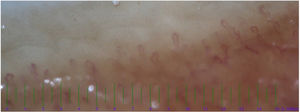 The increased diameter in the irregular dilatation in the nail fold capillaroscopy on a 2.5 years old Kawasaki patient.
