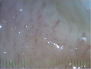 Abnormal morphology and loss of density of capillary vessels in a 14 months Kawaski patient with coronary involvement.