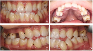 Intraoral view of the patient (1 week after surgery). (A) Anterior open-bite with dental crowding; (B) high-arched palate; (C and D) bilateral posterior cross-bite with dental crowding.