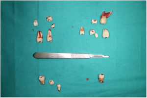 Extracted teeth and aligned with intraoral positions.