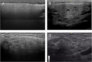 Parotid longitudinal scan assessment. Grade 0 (A), grade I (B), grade II (C), grade III (D).