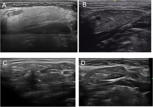 Submandibular longitudinal scan assessment. Grade 0 (A), grade I (B), grade II (C), grade III (D).
