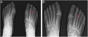 Non-weighbearing (A) and weightbearing (B) anteroposterior radiographs of the patient