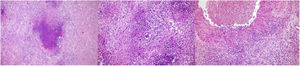 Microscopic examination of a single orchidectomy specimen with haematoxylin-eosin stain. (A) Geographic necrosis. (B) Necrotising granuloma. (C) Vasculitis.