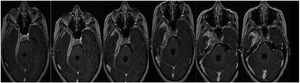 MR T1 sequence with contrast showing temporal pachymeningeal thickening around vascular and nerve structures and the cerebral oedema.