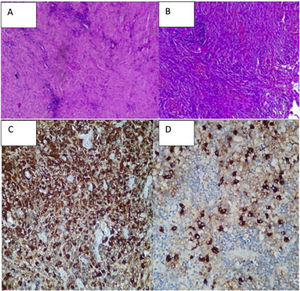 (A and B) These correspond to the microscopic visualization which shows lymphoplasmacytic infiltrate and swirled fibrosis. (C) Sample of IgG cells staining. (D) Staining for IgG4+.