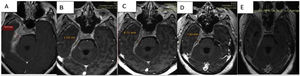 Successive MR T1 sequences in the evolution of the patient. From (A) basal lesion with approximately 2cm thickening, to (D) after treatment with steroids and rituximab, showing the clear improvement in the thickening and the oedema. (E) Late slices showing zones of fibrosis.