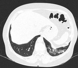 Chest CT scan of a 62-year-old woman with long-standing seropositive rheumatoid arthritis and interstitial lung disease.