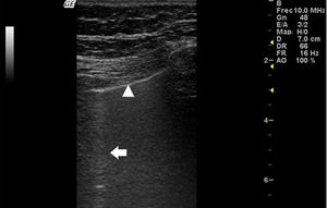 Lung ultrasound performed on the same patient as in Fig. 2 with GE Logiq 3 equipment, with 10–14 MHz multifrequency linear transducer, with the patient in a seated position and transducer in longitudinal direction. The arrow points to a B line. The triangle points to the pleural line, which is irregular in appearance. Note the absence of A lines.