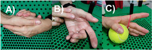 A) Manual traction of the trapeziometacarpal joint; B) massage of the thumb muscles; C) active exercises and/or with resistance for the first dorsal interosseous muscle.