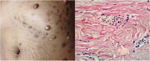Multiple firm hyperpigmented nodules on the chest (a) of a 27-year-old woman (b) Proliferation of myofibroblasts and haphazardly arranged thick hyalinized collagen bundles (H&E ×100).