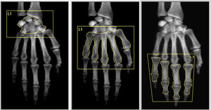 Hand images derived from DXA showing three analyzed ROI using a modified technique in Hologic device: (A) carpus. (B) metacarpal bones and (C) phalanges.