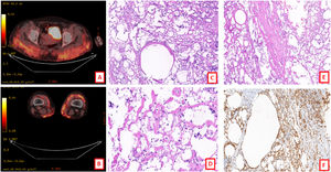 (A, B) PET-CT showing inflammatory tissue reaction to synthetic macromolecules at the lower lumbar level and gluteal area, with probable migration of the same to lower extremities and right anterior rectus muscle. (C) Membrano-cystic bodies formed by lipid vacuoles and surrounded by giant cells (HE ×100). (D, E) Fibrosis and steatonecrosis (HE ×100). (F) Immunohistochemistry with CD68 antibody marking histiocytes and giant cells surrounding membrano-cystic bodies (HE ×100).
