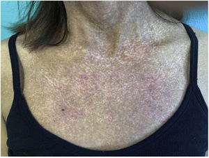 Widespread hypopigmented lesions. Dyschromia with salt and pepper pattern.