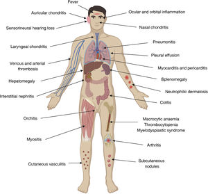 Inflammatory and haematological manifestations of VEXAS syndrome. Created with BioRender.com.