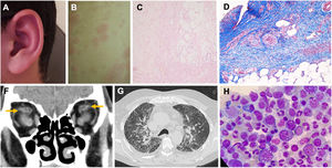 Manifestations of VEXAS syndrome. (A) Auricular chondritis. (B) Erythematous and oedematous plaques and papules suggestive of Sweet’s syndrome. (C) Septal panniculitis with significant necrosis, fibrosis, and scant perivascular lymphocytic inflammation. (D) Neutrophilic and granulomatous vasculitis affecting medium-sized arteries. F) Simple CT scan of the orbits in coronal section showing evidence of previous orbital myositis, with central hypodensity of the superior rectus muscles (arrows). (G) Chest CT showing bilateral pulmonary infiltrates. (H) Characteristic vacuoles in myeloid precursor cells in bone marrow aspirate.