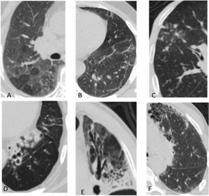 Typical MSCT findings of interstitial lung abnormalities. (A) Ground glass abnormalities, (B) reticular abnormalities with ground glass opacities, (C) tree in bud appearance, (D and E) traction bronchiectasis with reticulation and ground glass attenuation, and (F) honey combing demonstrated as clustered cystic air spaces.