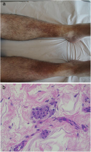 a) Large, flat, large, brown, pigmented lesion on the anterior aspect of the legs and feet. b) Lobular inflammatory infiltrate with histiocytes and multinucleated giant cells, both with xanthosis changes, associated with areas of lipodystrophy/steatonecrosis.