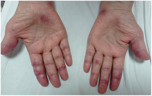 Erythematous-violaceous macules on the palms and palmar region of the fingers with incipient signs of ulceration on the fourth finger of the left hand, typical cutaneous findings of anti-MDA5 dermatomyositis.