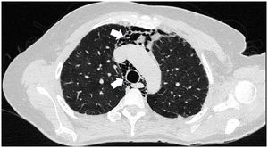 High resolution chest CT scan demonstrating isolated pneumomediastinum, with no evidence of pneumothorax or subcutaneous emphysema.