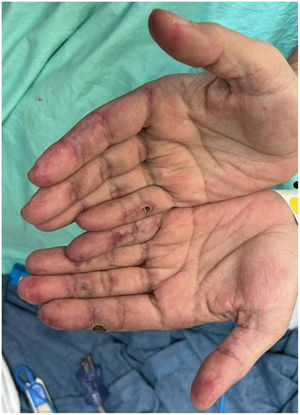 Erythematous-violaceous lesions and ulcers on the palms, typical in anti-MDA5 dermatomyositis.