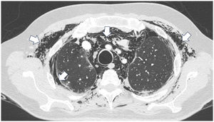 Chest CT angiography demonstrating extensive pneumomediastinum, in addition to concomitant pneumothorax and subcutaneous emphysema.