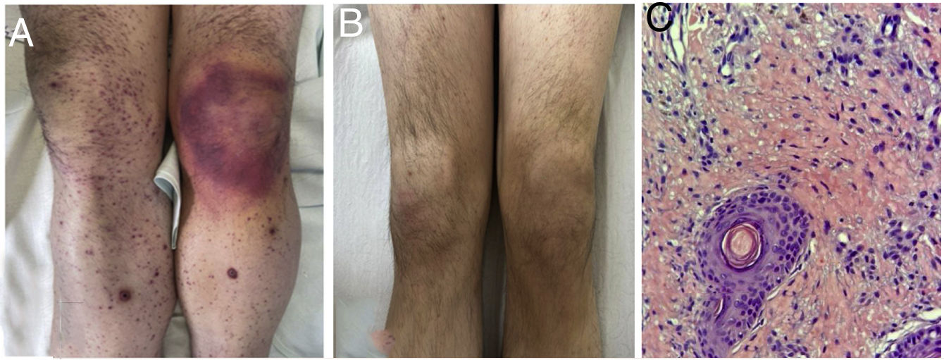 Pictures Of Scurvy On Skin