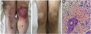 A. Lower extremities at the time of diagnosis. B. Lower extremities following treatment. C. Pathology study of the purpuric lesion biopsied.