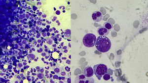 Bone marrow biopsy from our patient number 2. Giemsa-stained histological specimen. Optical microscope view at 50x magnification (×50, left) and at 100x magnification (×100, right). The myeloid series is well represented, with no maturational arrest and no increase in blast cells. Particularly noteworthy is the cytoplasmic vacuolation in myeloid cells, characteristic of VEXAS syndrome. In the sample obtained we also observed minimal dysplastic changes in the erythroid series, as well as the presence of marked eosinophilia.