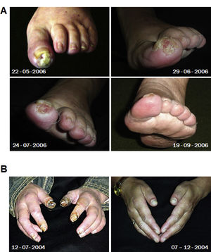 Effect of gravity therapy on digital vascular lesions in patients with systemic sclerosis. (A) Images of the effect of gravity on a digital ulcer of a left lower limb at baseline and its evolution with gravity in a patient with SSc. (B) Evolution of digital necrosis in a patient with mixed connective tissue disease at baseline (left) and post-GT (right). These images do not correspond to patients in this study. Adapted from: Isasi et al., 2022, doi: 10.3389/fphys.2022.952723. Photos courtesy of the Gravitational Therapy Centre.