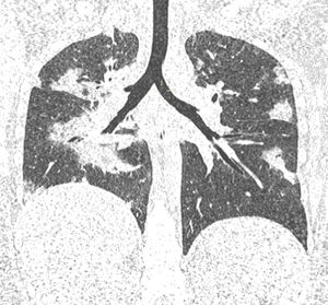 Coronal computed tomography of the chest with evidence of multilobar ground-glass images affecting more than 50% of the pulmonary parenchyma.