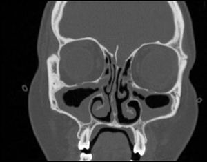 Computed tomography scan of the paranasal sinuses with evidence of paranasal hypertrophy and chronic sinusitis.