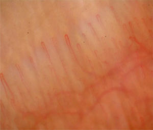 Nailfold capillaroscopy image showing normal hair pin capillaries with prominent sub papillary venous plexus in healthy control person.