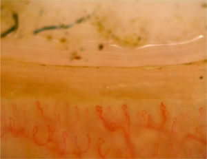 Nailfold capillaroscopy image showing tortious capillaries with prominent sub papillary venous plexus in case of membranous nephropathy.