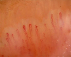 Nailfold capillaroscopy image showing dilated tortious capillaries in a case of class IV lupus nephritis.