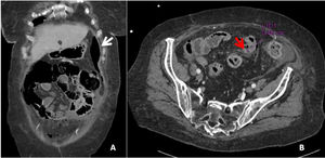 Extensive diffuse pneumoperitoneum associated with a significant amount of free fluid predominantly in left parietocolic gutters (white arrow). In the distal ileum (approximately 10–15 cm from the ileocecal valve) there is a 5 mm parietal solution of continuity, suggestive of perforation (red arrow).