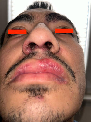 Nasal ulcers.