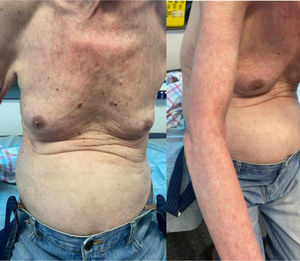 Progression of skin activity after the first dose of treatment.