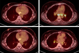 Positron emission tomography (PET) scan. Multiple hiliomediastinal hypermetabolic adenopathies with a characteristic pattern of granulomatous disease were observed, with those located at 4 R (SUVmax 15.26) and 7 (SUVmax 15.05) of note due to their uptake rate. Positron emission tomography (PET) scan. Multiple hiliomediastinal hypermetabolic adenopathies with a characteristic pattern of granulomatous disease were observed, with those located at 4 R (SUVmax 15.26) and 7 (SUVmax 15.05) of note due to their uptake rate.