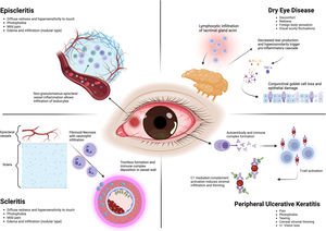 Pathogenic mechanisms of RA-associated ocular manifestations.