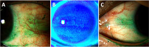 Ocular surface staining score (OSS) from the Sjögren